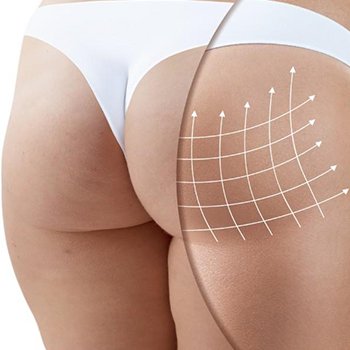 Lipofilling des fesses