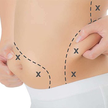 Liposuccion