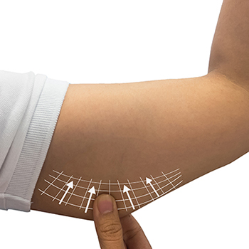 Lifting des bras : Brachioplastie