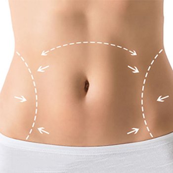 Abdominoplastie
