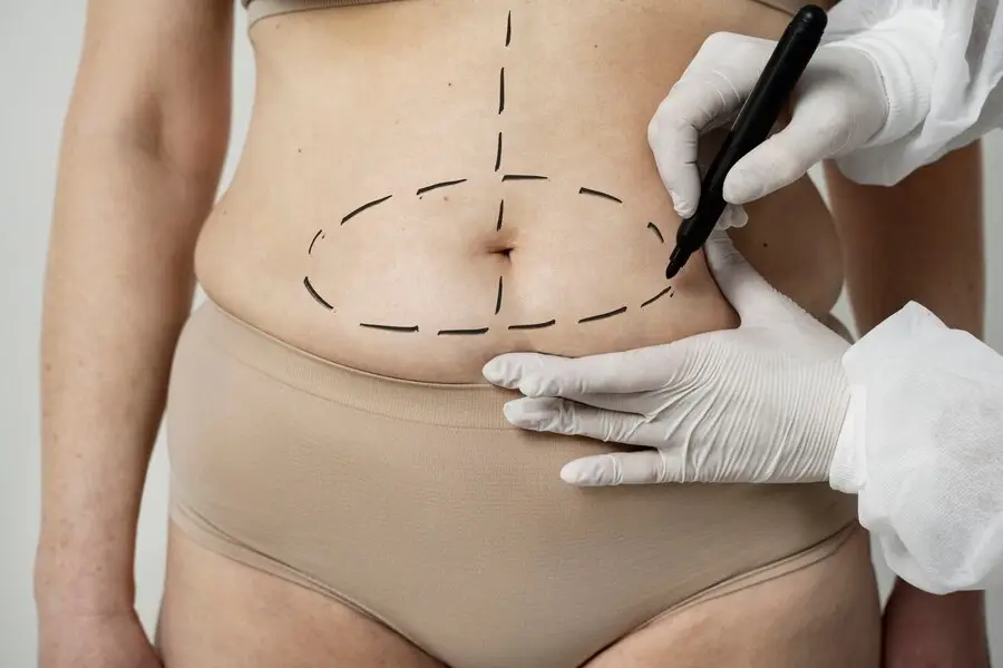 Plastie abdominale ou liposuccion : quelle est la meilleure option pour vous ?