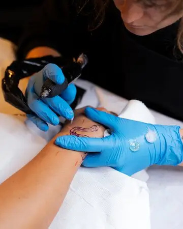 détatouage au laser 